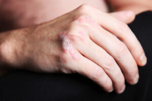 Unidad de Psoriasis