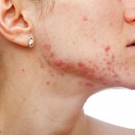 ACNE FOTO