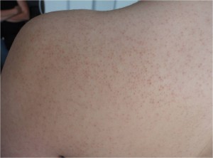 Queratosis pilar
