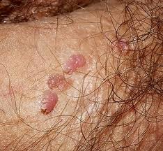 verrugas genitales-condilomas