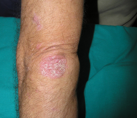Psoriasis en placas Imagen de psoriasis en placas localizada en codo
