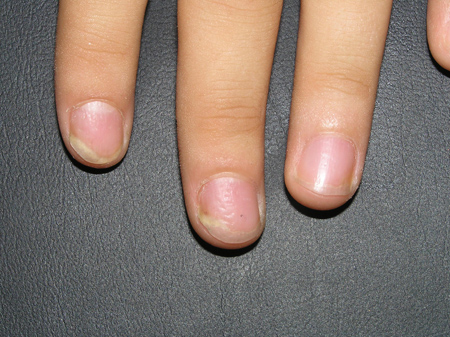 Psoriasis ungueal Imagen de uñas afectadas por psoriasis ungueal