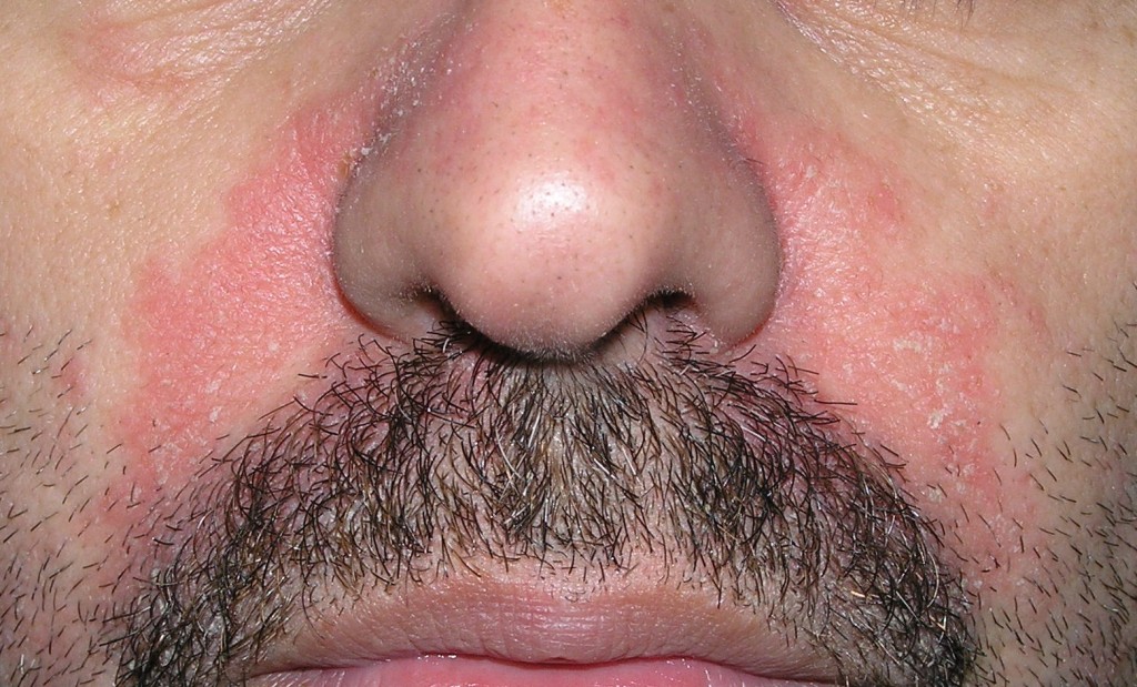 Dermatitis seborreica surcos nasolabiales