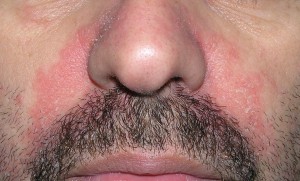 Dermatitis seborreica surcos nasolabiales