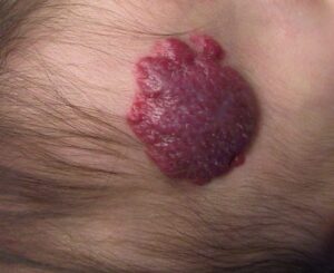 Angioma infantil