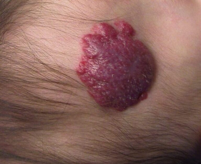 Angioma infantil