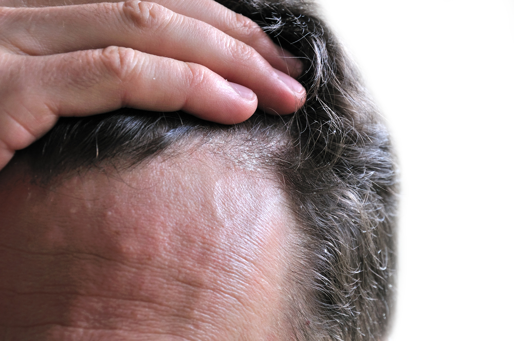 Caspa. En este caso producida por una dermatitis seborreica.