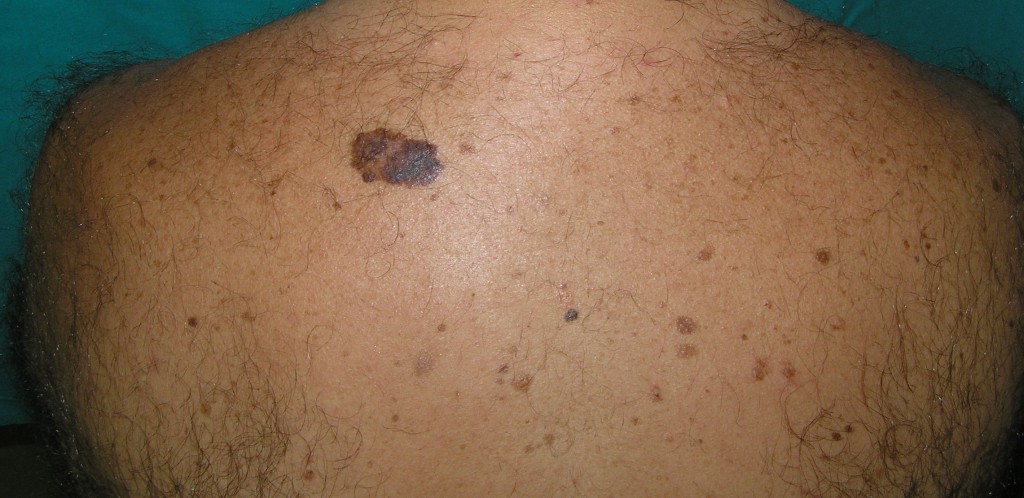 Melanoma en la espalda