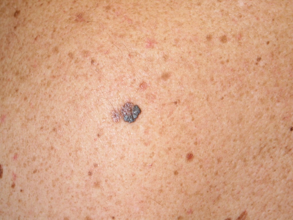 Melanoma