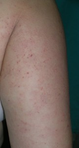 El picor de la dermatitis atópica tiene una buena respuesta a la fototerapia