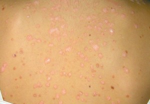 La psoriasis en gotas responde muy bien al tratamiento con fototerapia