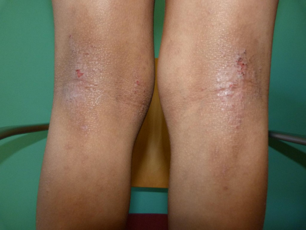 La dermatitis atópica aparece con frecuencia en la cara posterior de las rodillas (región poplítea) La dermatitis atópica aparece con frecuencia en la cara posterior de las rodillas (región poplítea)