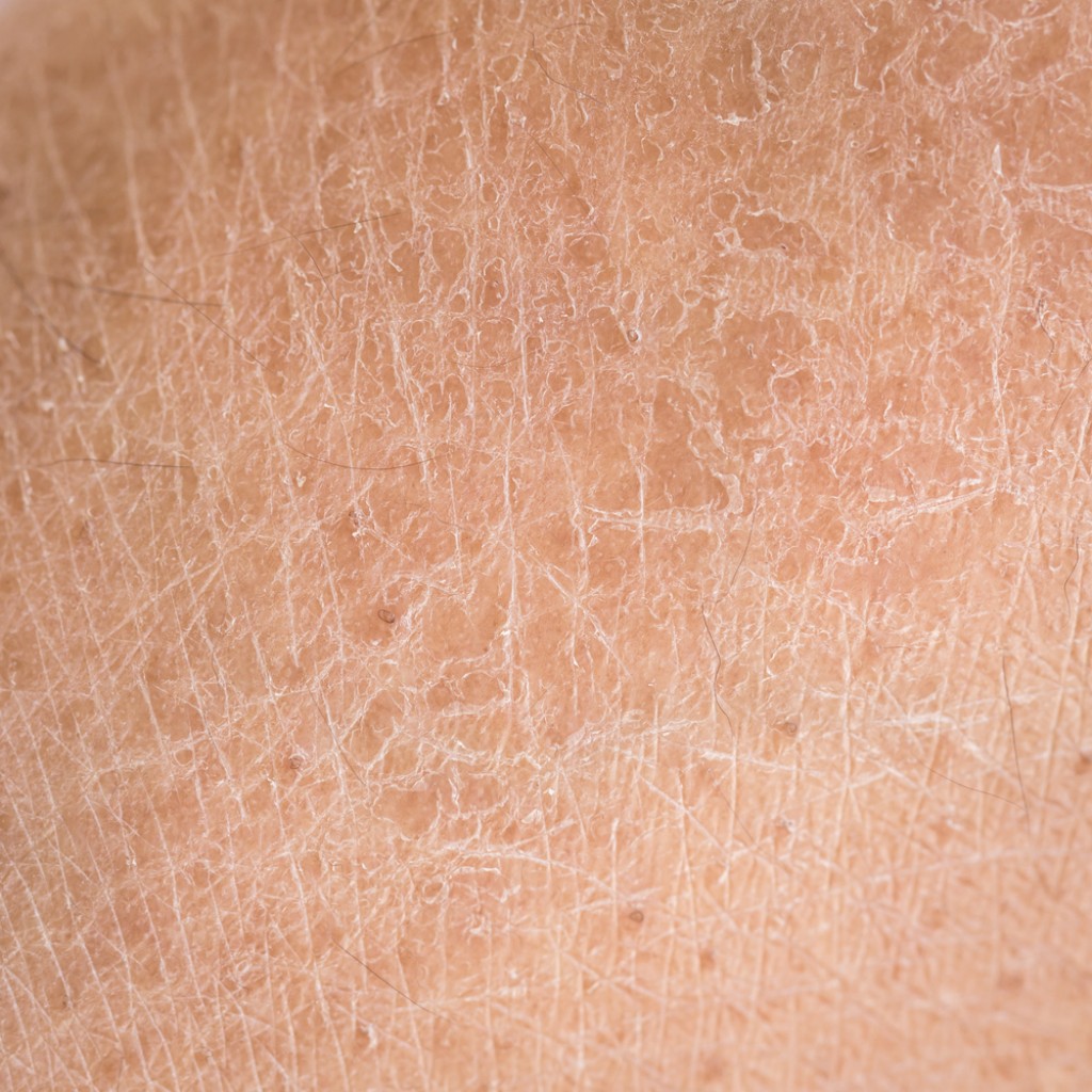 Piel seca en detalle