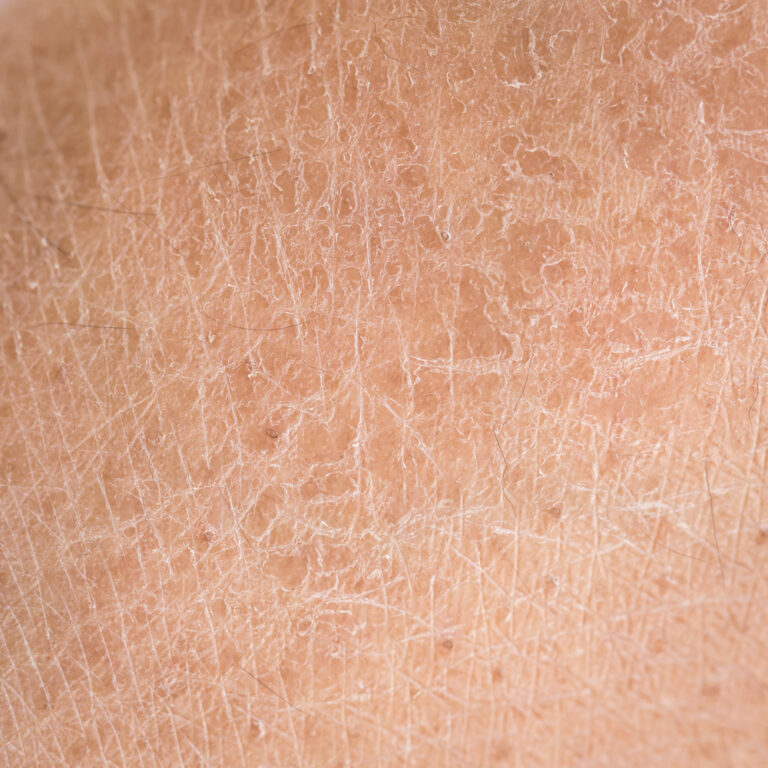 Piel seca en detalle