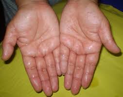 Exceso de sudoración o hiperhidrosis en las palmas Exceso de sudoración o hiperhidrosis en las palmas