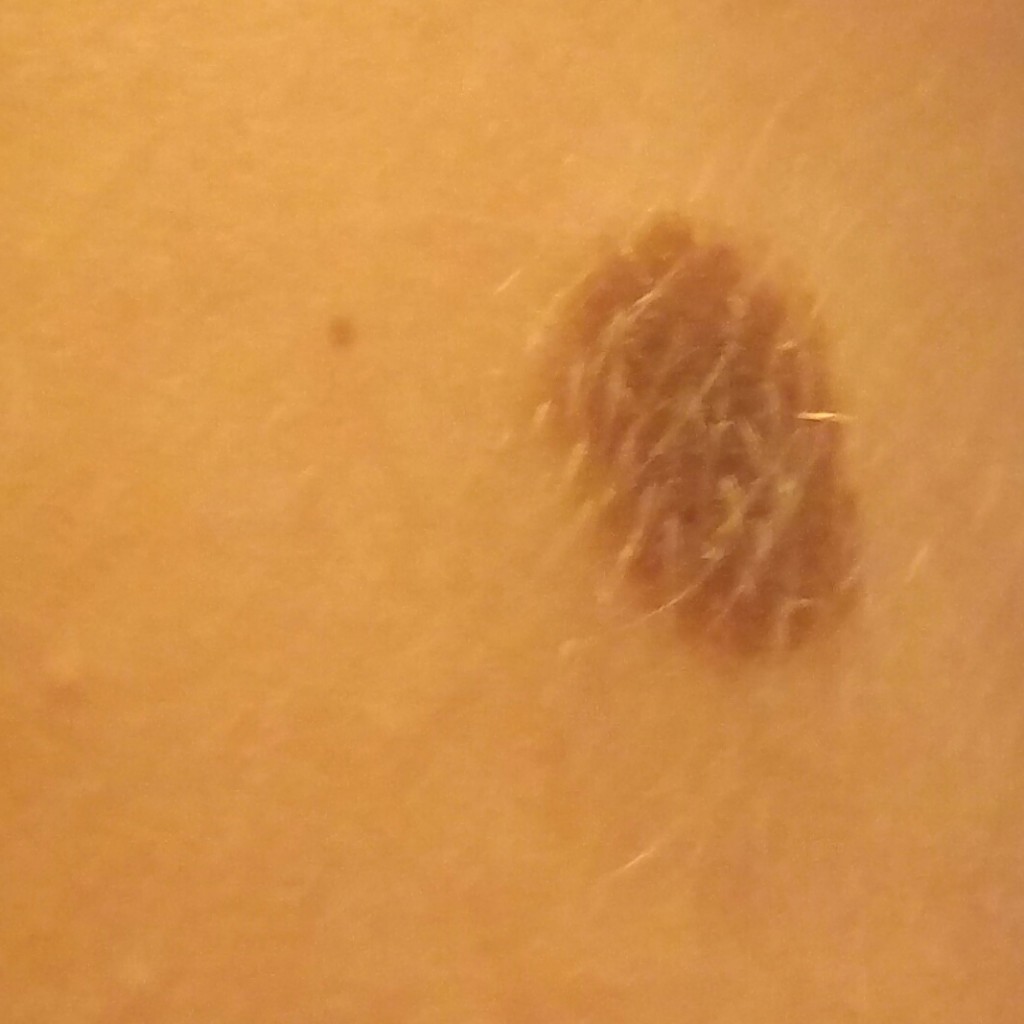 Nevus