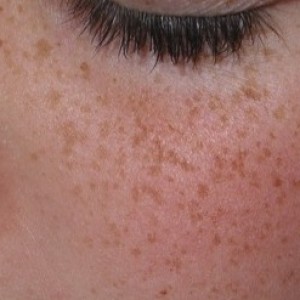 Ephelides or freckles on the cheek