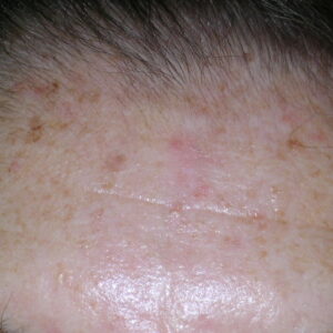 Actinic lentigines on the forehead