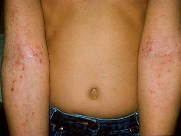 Atopic dermatitis often affects the anterior aspect of the elbows.