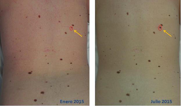 La dermatoscopia digital puede detectar cambios microscópicos en los lunares