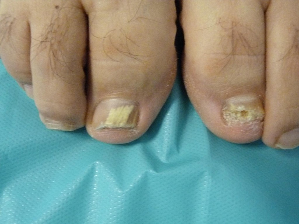 Onicomicosis que afecta a varias uñas del pie