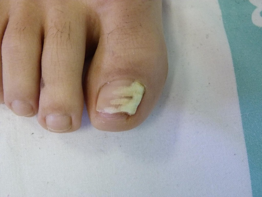 Onicomicosis: infección de una uña por hongos de tipo dermatofito