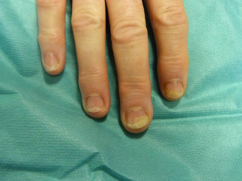 Alteraciones de las uñas en la Psoriasis