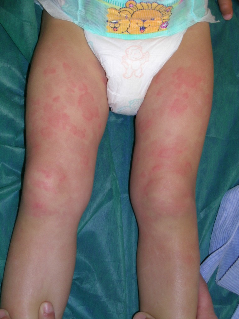 habones en los muslos de un niño de 20 meses