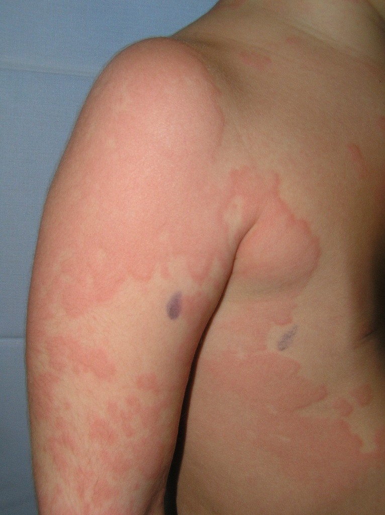 Urticaria: habones coalescentes