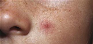 Spider vein on the cheek