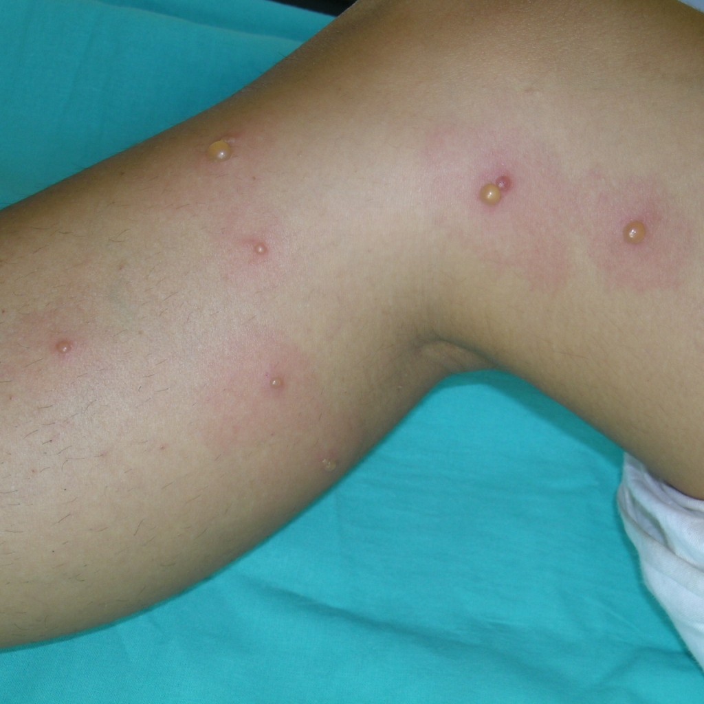 picaduras con ampollas