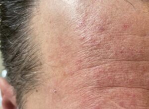 Dermatitis seborreica