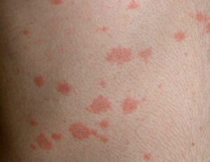 Pitiriasis_Rosada_Gilbert