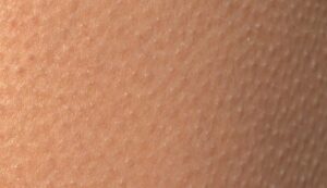 queratosis_pilaris