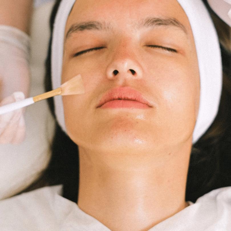 PEELING QUÍMICO
