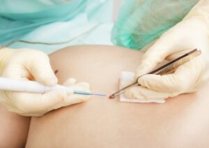 Dermatología Cirugía de Mohs