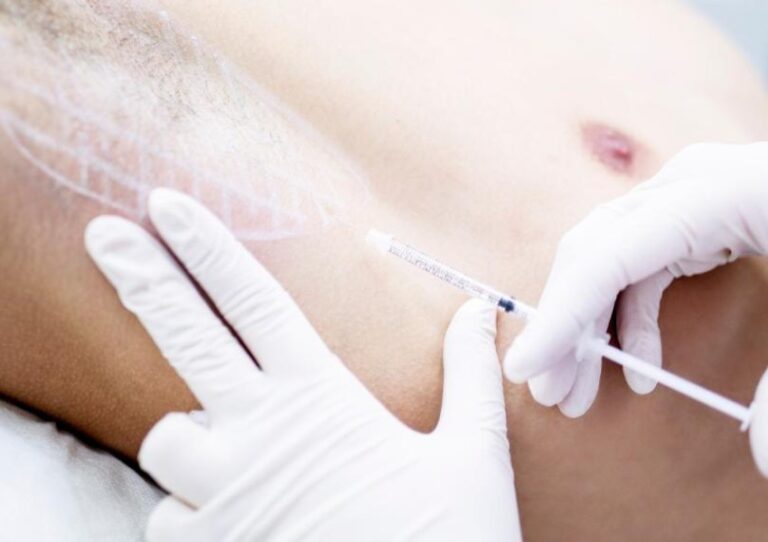 Hiperhidrosis exceso sudoración