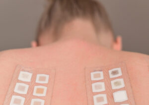 Dermatitis de contacto