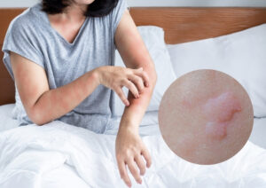 Urticaria