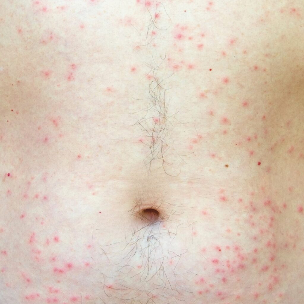 Foliculitis