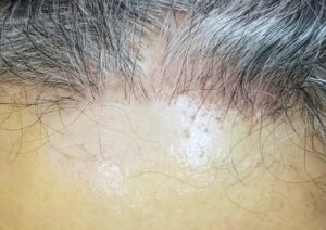 Alopecia