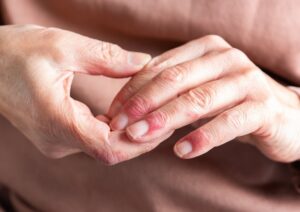 Dermatitis de manos