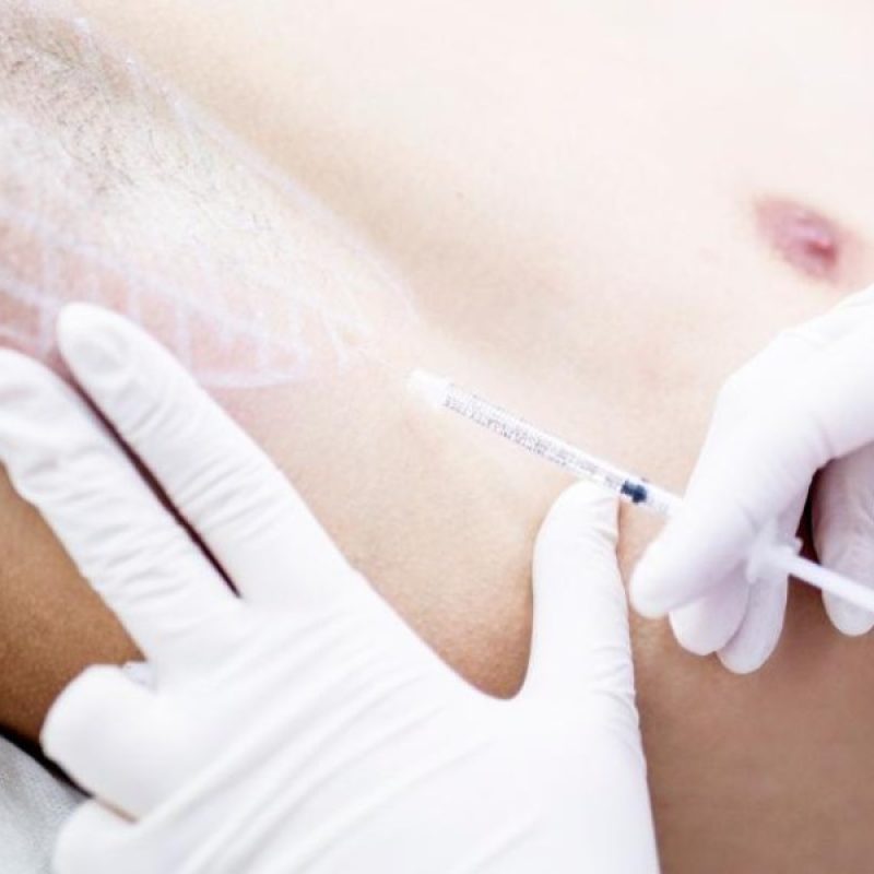 Hiperhidrosis exceso sudoración